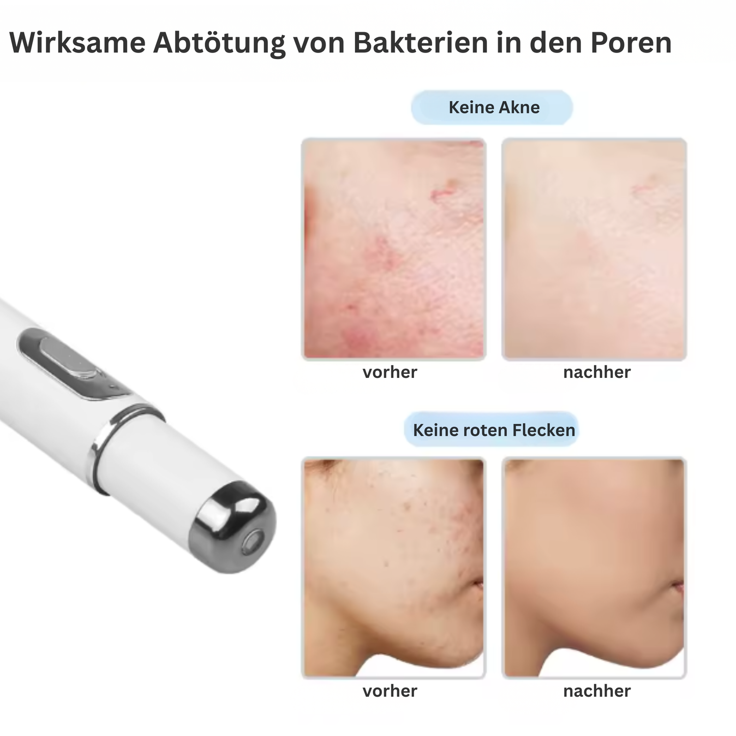 DermaBlue Pen – Blaulicht-Pen für klare, ebenmäßige & regenerierte Haut